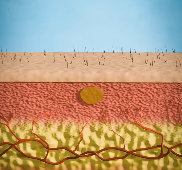 곤지름 초기증상