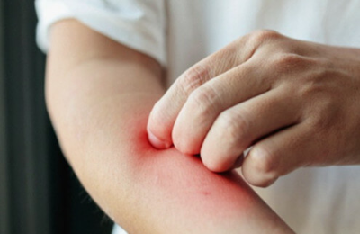 모기 물린 사람