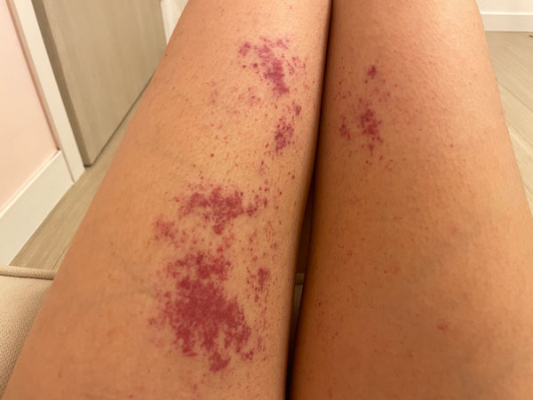 저온화상 증상 첫날