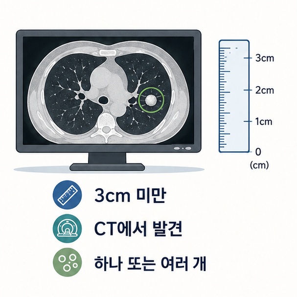 흉부 CT에서 지름 3cm 미만의 폐결절이 하나 또는 여러 개 발견될 수 있음을 보여주는 그림