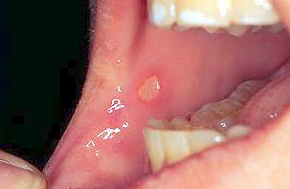아기 아구창 전염?! 성인 아구창 에이즈&amp;#44; 당뇨 환자에게서 잘 생겨요