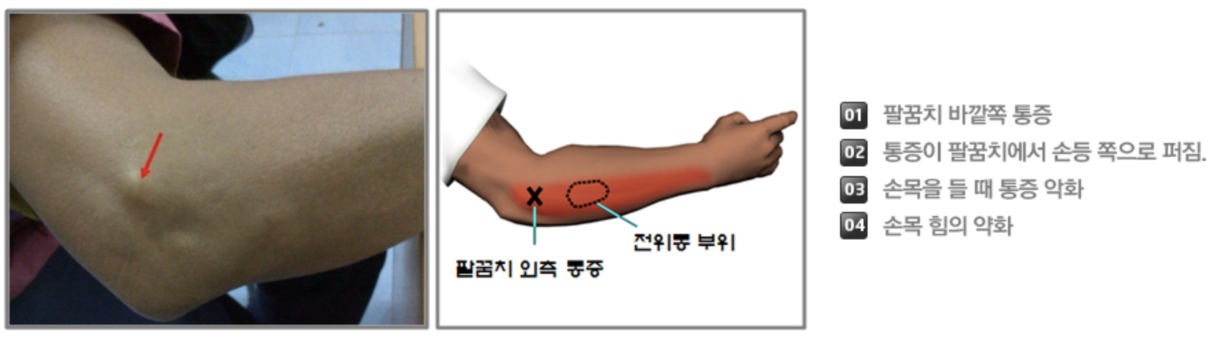 외상과염 증상