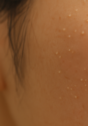 비립종 생기는 이유