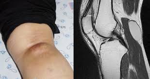 오금이 아픈 이유