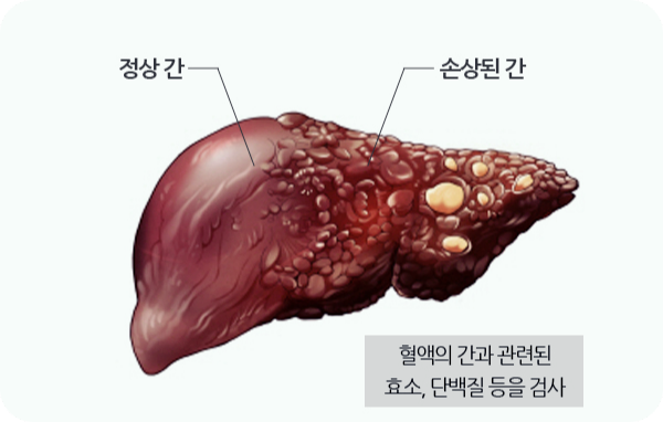 간수치가-높으면-나타나는-증상