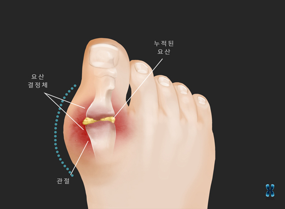 통풍 초기증상