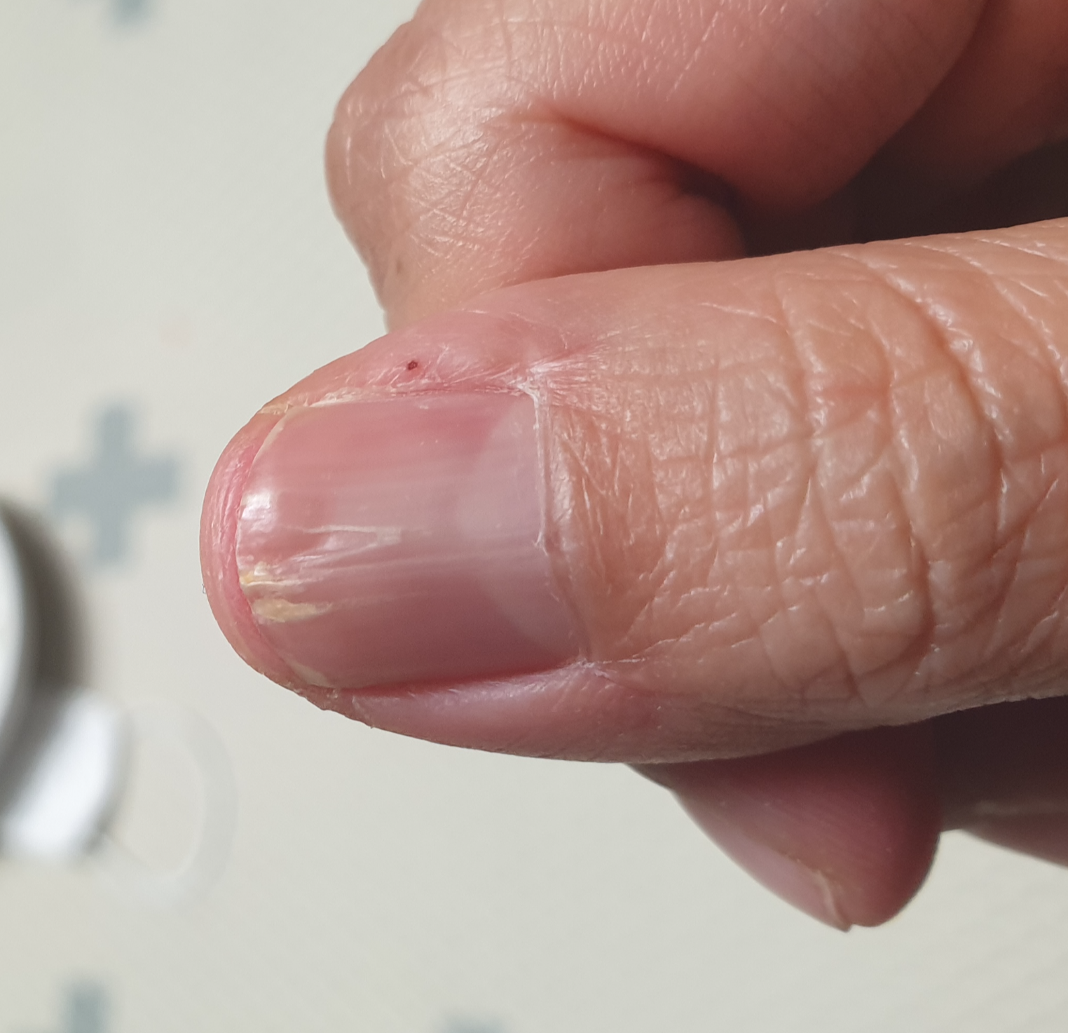 거의 완치된 손톱