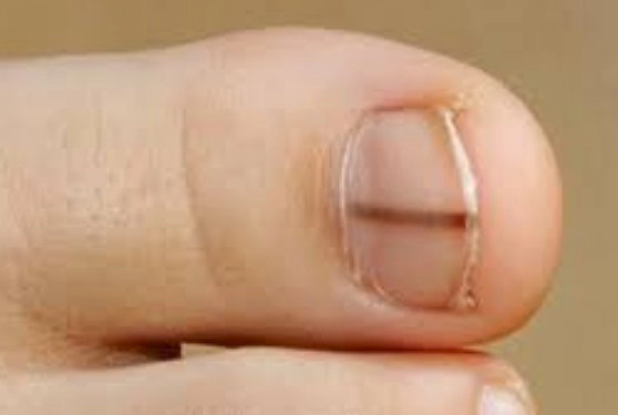 손발톱밑 흑색종 검사방법