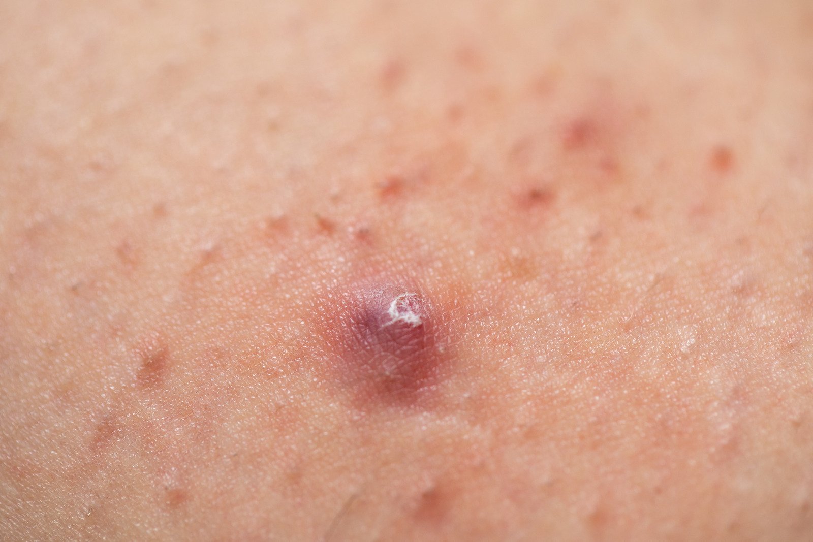 모소낭염(Folliculitis): 모낭에 염증이 생기는 피부 질환