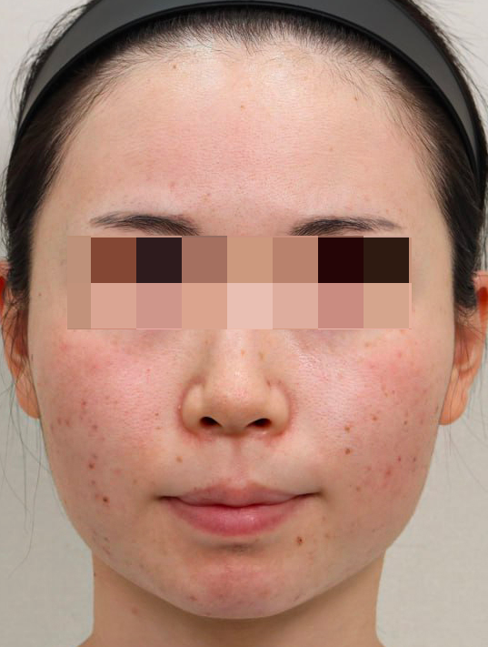 동안 얼굴 만들기 논현동 여드름 피부과