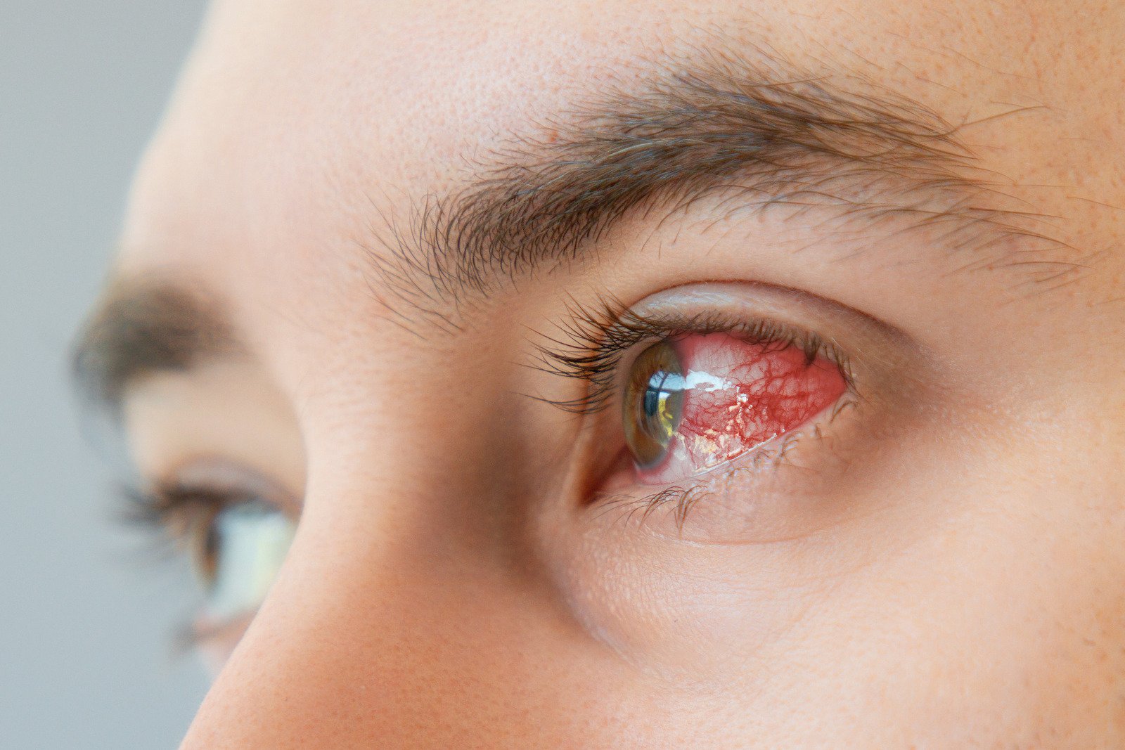 각막염(Keratitis) – 세균성 &amp; 바이러스성 감염과 콘택트렌즈 사용 시 주의사항