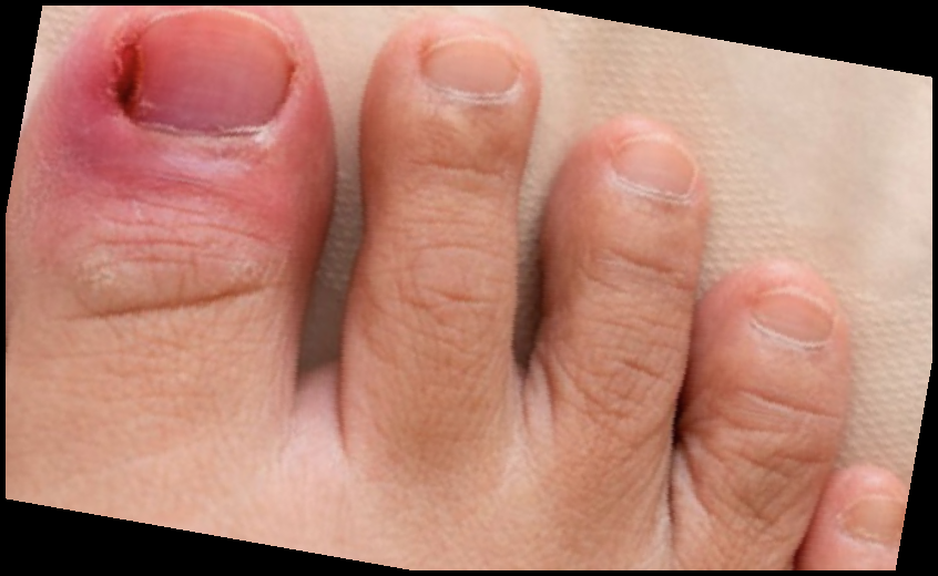 내성발톱 자가치료