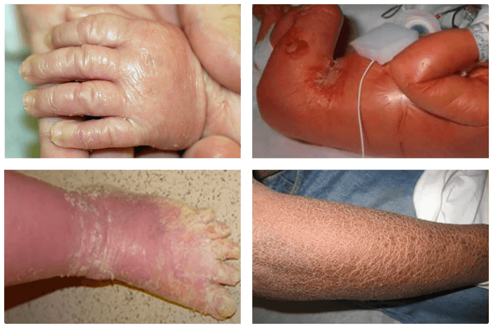 클로디온 베이비 -층판비닐증-어린선