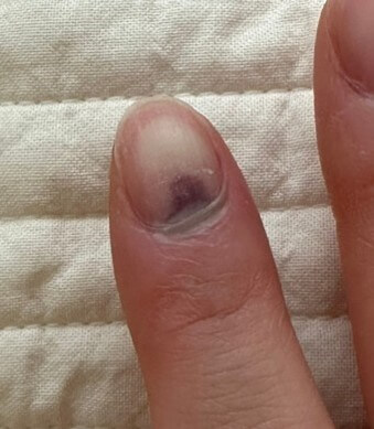 검지손가락에-검정색-먹이들어있는-손톱-아프겠다