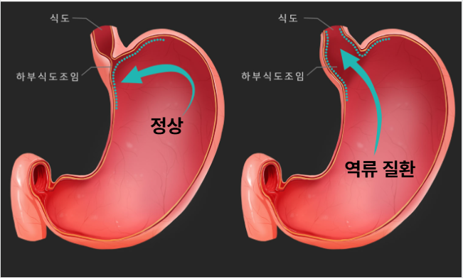 역류성식도염