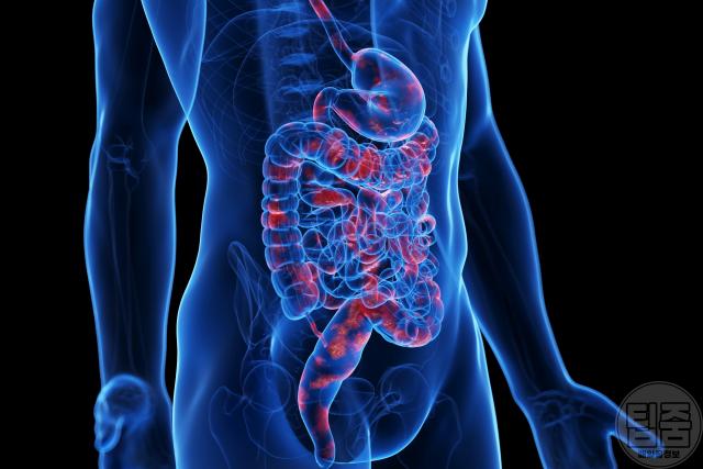 위염 증상 크론병