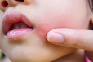 두드러기-치료방법