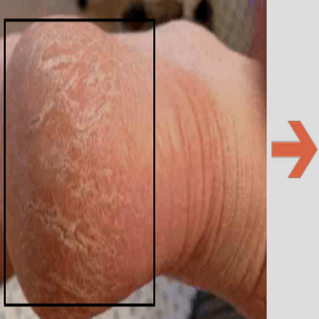 발각질 제거하기 전 모습