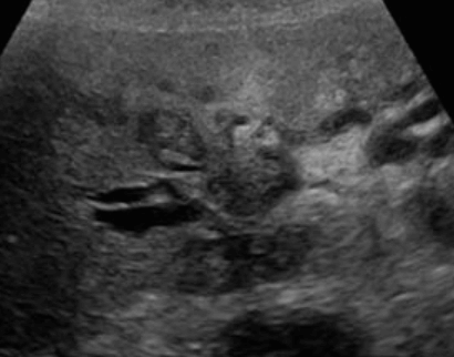  간문부 담관암(Klatskin&amp;#39;s tumor = Hilar cholagiocarcinoma)