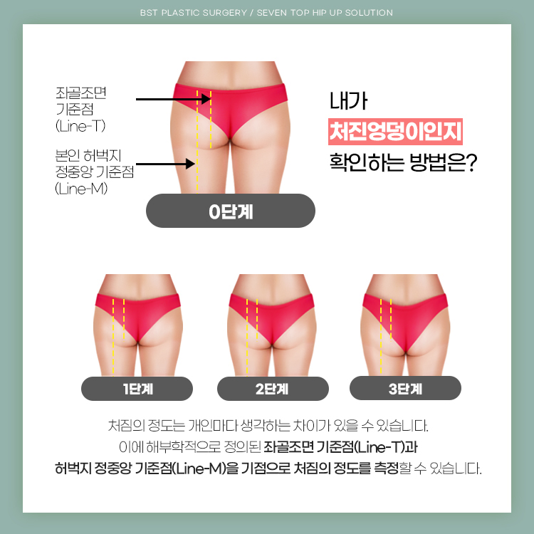 처짐의 정도는 개인마다 생각하는 차이가 있을 수 있습니다. 해부학적 기준으로 내가 처진엉덩이인지 확인해보세요.