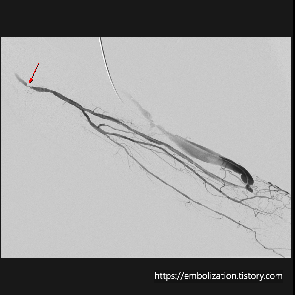 Severe stenosis at left distal brachial artery