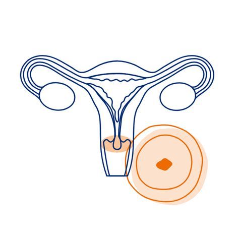 자궁경부조직검사