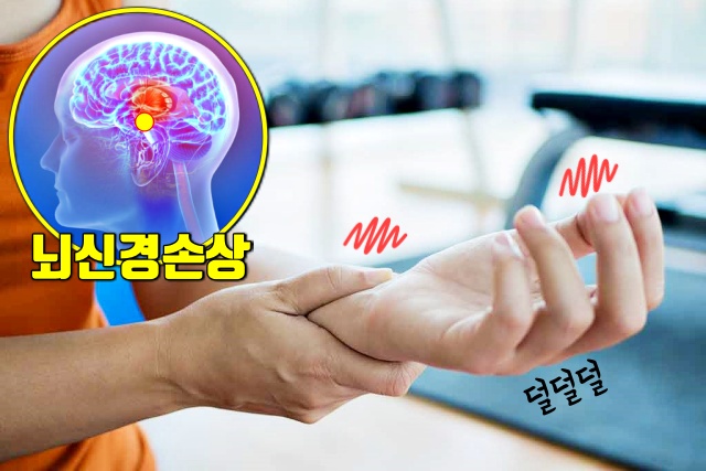 파킨슨병 증상, 의사 오진율, 의사 오진 대응 방안, 웰빙 건강 팁줌 매일꿀정보
