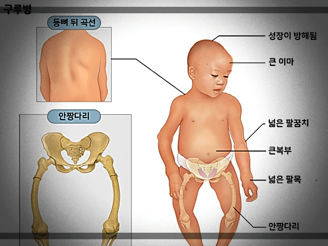 비타민D-구루병-및-부작용