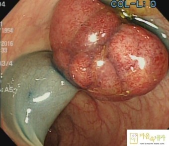 대장암에 좋은 음식 항암식품