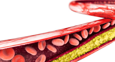 중성지방 낮추는 방법, 중성지방 정상수치