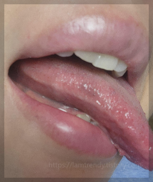 혀에 검은 점