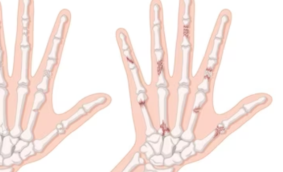 류마티스 관절염의 증상 1