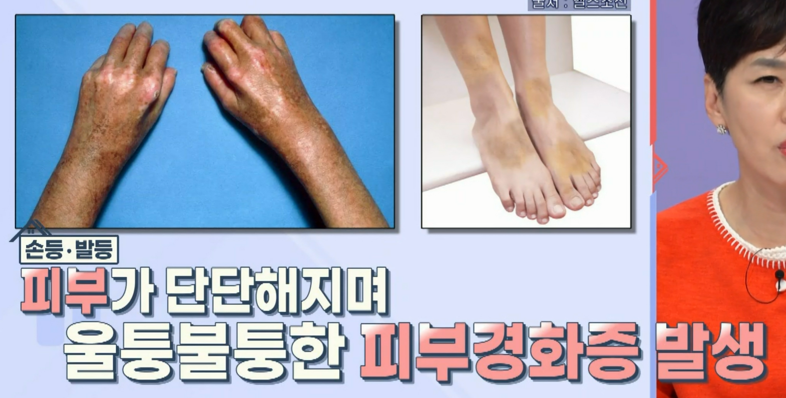 세리포리아 락세라타 효능