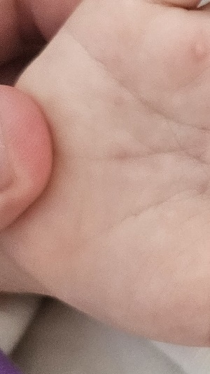 수족구병 증상 격리기간