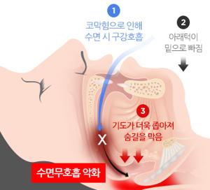코골이 수술