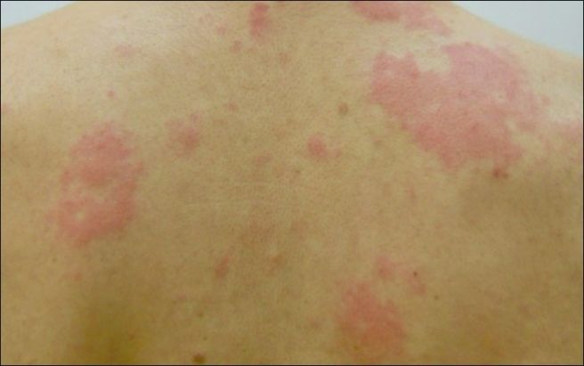 피부 발진 종류