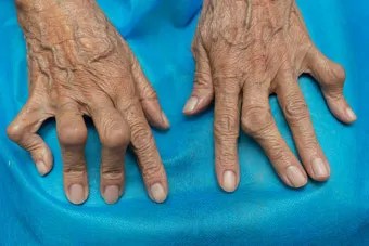 효과적인 류마티스 관절염 치료제 추천 약물 비교 가이드 2025 최신판_12