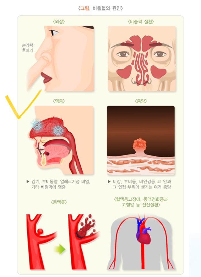 비출혈의 원인 관련사진, 출처:대한민국 질병관리청 국가정보포털