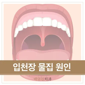 입천장 헐었을 때 면역력 저하 관련 증상과 영양 관리법_20