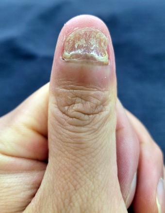 엄지-손톱에-세균이-들어-갉아먹고-있는-모습