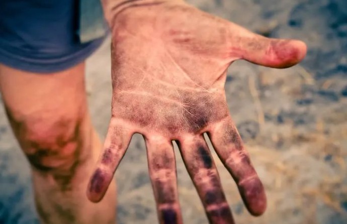 손가락 마디가 아픈 이유