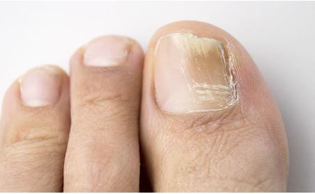 발톱 무좀 상태