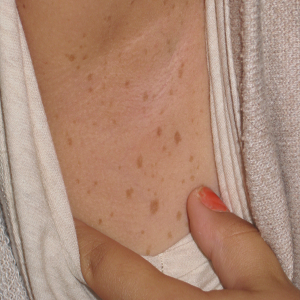 신경섬유종 초기 증상, 혹시 나도? 놓치면 안 되는 신호