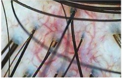 지성 두피 건성 두피 민감성 두피 탈모증상