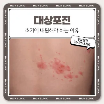 대상포진 치료방법에 대한 총정리 건강 질병관리_6