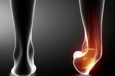 발목 접질렀을때 증상