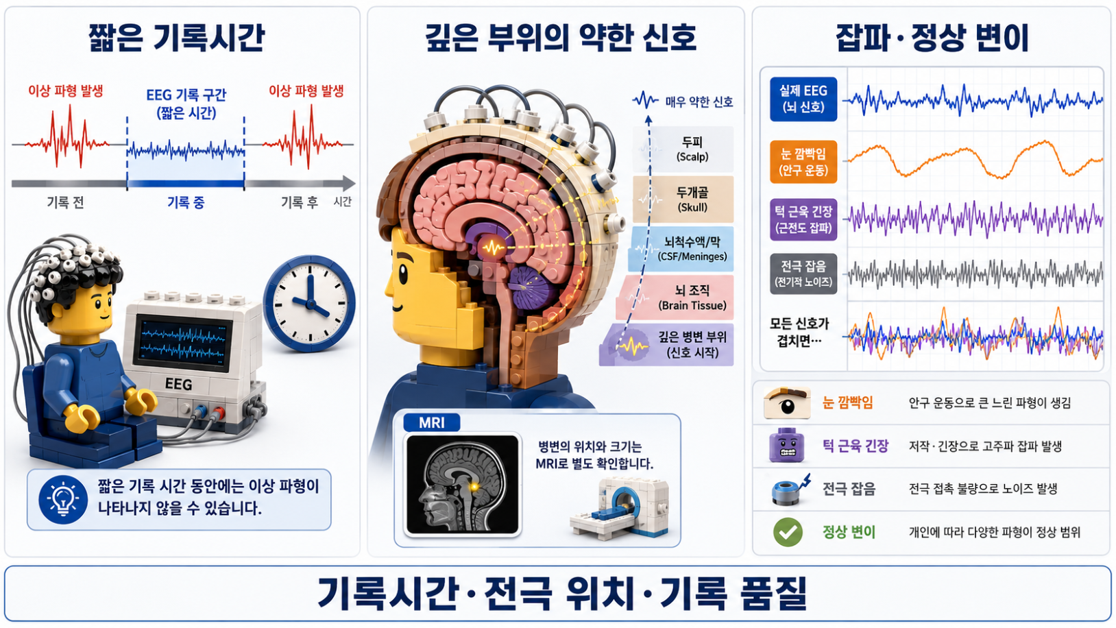 짧은 기록시간, 깊은 부위의 약한 신호, 잡파와 정상 변이에 따른 뇌파검사의 기술적 한계를 설명한 의료 인포그래픽
