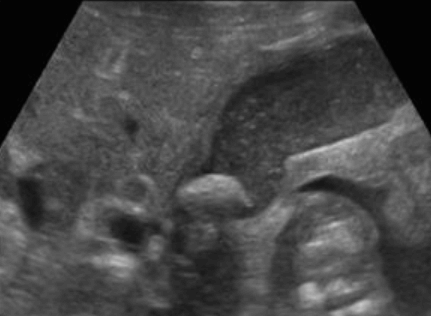 Mirizzi&amp;#39;s syndrom