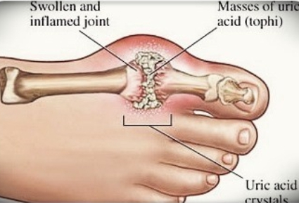 통풍발작 응급 대처 치료 방법 - 소염진통제 복용