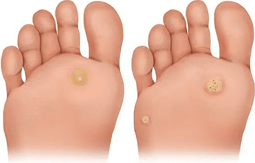 좌측 발은 티눈, 우측 발은 사마귀